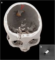 50 cal bullet hole ipad air gunned down with 50 caliber sniper, filmed with google glass in the process (video. Heavy Metal In Radiology How To Reliably Differentiate Between Lodged Copper And Lead Bullets Using Ct Numbers European Radiology Experimental Full Text