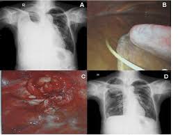 A loculated pleural effusion is the major radiographic hallmark of parapneumonic effusion or empyema (see fig. Thoracoscopic Plication For A Huge Thoracic Meningocele In A Patient With Neurofibromatosis Journal Of Cardiothoracic Surgery Full Text