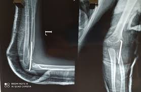 Image result for Radial Head Dislocation