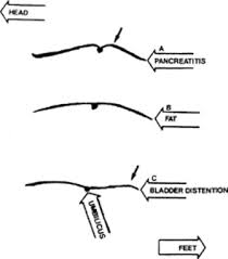 Image result for Succussion Splash