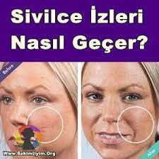 Yuzdeki Sivilce Lekeleri Nasil Gecer Dogal Maske Tarifleri Yuzdekisivilce Sivilce Sivilcenasilgecer Sivilcelekeler Sivilce Izi Cilt Urunleri Cilt Bakimi