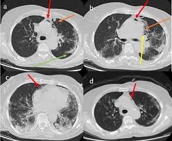 This leads to a loss of negative pressure between the two pleural membranes, which can result in the part. Unusual Presentations Of Covid 19 Pneumonia On Ct Scans With Spontaneous Pneumomediastinum And Loculated Pneumothorax A Report Of Two Cases And A Review Of The Literature Sciencedirect