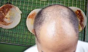 In addition, if you apply this treatment over an extended period, it will make all those bald spots caused by hair loss disappear. Hair Loss Treatment Onion Juice Promotes Hair Regrowth And Is Backed Up By Studies Express Co Uk