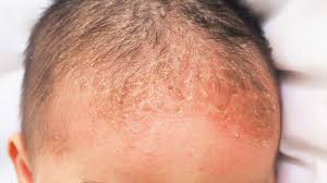 Image result for yellow scabs on the face in children