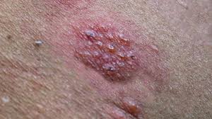 Image result for Varicella zoster on human skin