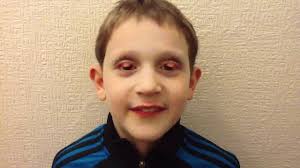 We did not find results for: Flipping Your Eyelids Inside Out