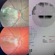 Image result for Acute Vision Loss