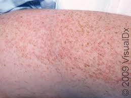 Image result for sweat rash on back