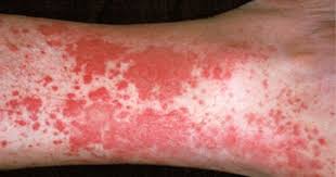 The initial appearance may resemble hives , with small red spots or bumps on the lower legs, buttocks, knees , and elbows. Pin On Skin