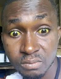 Hi Could someone bring this photo into focus ,my eyes are blue. If possible  take the redness away from my eyes & nose .I'm happy to keep my background  & clothing colour,