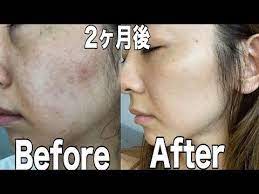 marina takewaki youtube ニキビ スキンケア 肌荒れ