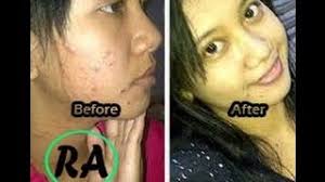 Gozout ubat gout dan kencing manis paling berkesan dan via 4 vitamin paling mujarab jadi ubat jeragat via norfaziela.com. Ubat Jerawat Dan Jeragat Di Farmasi Ubat Jerawat Untuk Remaja Lelaki Youtube