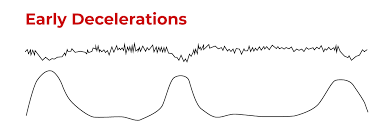 Image result for Non-Stress Test