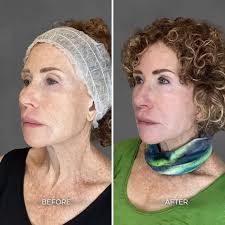 Albuquerque Laser Treatment Before & After Gallery: Chrome Aesthetics