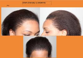 Hair transplants for african american hair hair transplant on those of african american descent is more difficult than caucasian or asian ethnicities due to the curly hair and root. My U Fue Hair Transplant Women No Shave No Shaving No Short Hair Cut