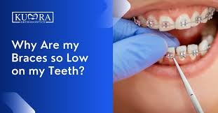 What Is The Best Age For Braces? - Splash Orthodontics