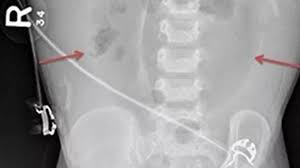 Image result for Necrotizing Enterocolitis