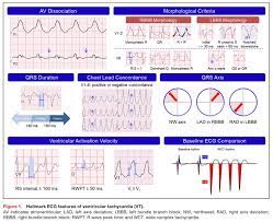 Rhythm monitoring with a loop recorder or device. Hallmark Ecg Features Of Ventricular Tachycardia Vt Av Grepmed