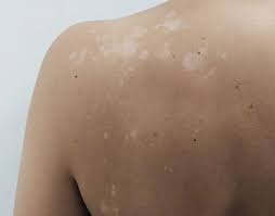 Panau alias panu di wajah sangat mengganggu penampilan seseorang apalagi seorang wanita. Tak Perlu Belanja Besar Ini 6 Cara Anda Boleh Rawat Hilangkan Panau Pada Badan Maskulin