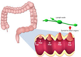 pathology report guide my colon cancer coach