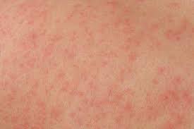 Syp Na Kozhe Soprovozhdayushayasya Zudom I Bolevymi Oshusheniyami O Chem Govorit Simptom Kak Dermatologi Diagnostiruyut Bolezn Sredstva I Sposoby Lecheniya