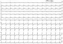 Some of the proliferative lesions that used to grouped here do have some premalignant potential. Myocardial Infarction Due To Coronary Thrombus Formation In A Postmenopausal Woman With Breast Cancer After Initiation Of Letrozol Therapy International Journal Of Cardiology
