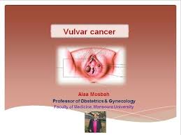 Image result for Vulvar Cancer