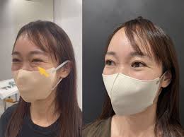 目の下 笑う と 膨らむ