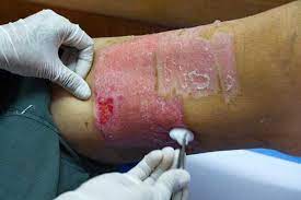 Skin Graft Scar Skin Graft Treatment Best Cream For Skin Graft