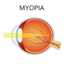 Image result for Myopia