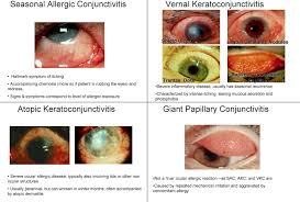 Image result for Allergic Conjunctivitis