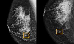 This abnormal growth often leads to the development of a puckering is indentations in the breast and may be the first visible sign of breast cancer. Ai System Outperforms Experts In Spotting Breast Cancer Breast Cancer The Guardian