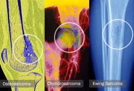 The orthopedic doctor will take care of the permanent cast. Visual Guide To Bone Cancer