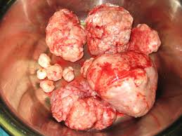Image result for fibroid