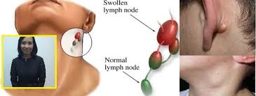 Jika ia telah merebak ke bahagian lain, penghidap akan mengalami tanda. Tanda Tanda Kanser Limfoma