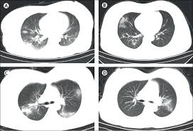 It was first identified in december 2019 in wuhan,. Clinical Features And Obstetric And Neonatal Outcomes Of Pregnant Patients With Covid 19 In Wuhan China A Retrospective Single Centre Descriptive Study The Lancet Infectious Diseases