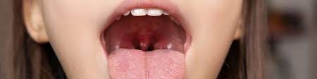 Image result for Tonsillitis