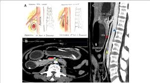 A 27 Year Old Male With Superior Mesenteric Artery Syndrome A Shows Download Scientific Diagram