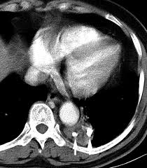 Image result for Broncholithiasis