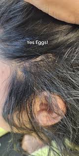 Image result for lice vs dandruff