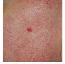 Image result for Merkel Cell Carcinoma
