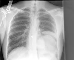Treatment of bladder cancer depends on the stage of the cancer. Parasitic Infections Of The Lung A Guide For The Respiratory Physician Thorax