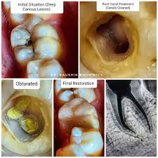 Image result for Pulpitis