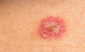 Image result for Eczema nummulare