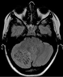 Clippers syndrome is a chronic lymphocytic inflammation with pontine perivascular enhancement responsive to steroids. Https Www 2013 Roentgenkongress De Media Document 3173 Rk Sp 102 1 Forsting Pdf