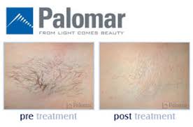 The palomar starlux 500 uses both laser technology and intense pulse light (ipl) technology in the treatment of various dermatological conditions. Laser Vs Laser Sandton Aesthetic Institute Blog