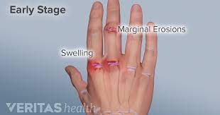 My case was due primarily to keyboard typing, although it may have been exacerbated by bicycling and yard work. Hand Rheumatoid Arthritis Ra Signs And Symptoms