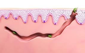 Ringorm dermatofytose er en smittsom soppinfeksjon i det ytterste laget av huden forårsaket av en soppgruppe som kalles dermatofytter. Utslett Og Hudsykdommer