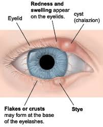 Image result for milium cyst on eyelid