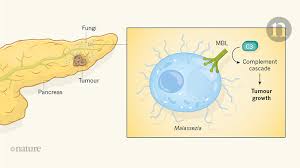 As the tumor grows, patients may experience some of these common symptoms: Fungi Accelerate Pancreatic Cancer